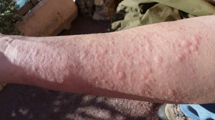 Allergic Dermatitis representation