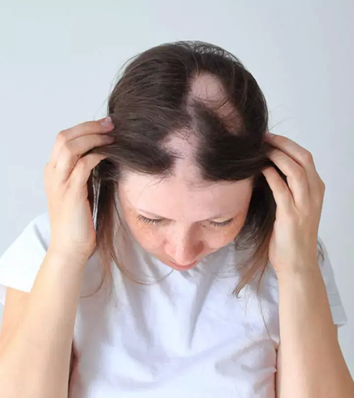 Hair Loss representation