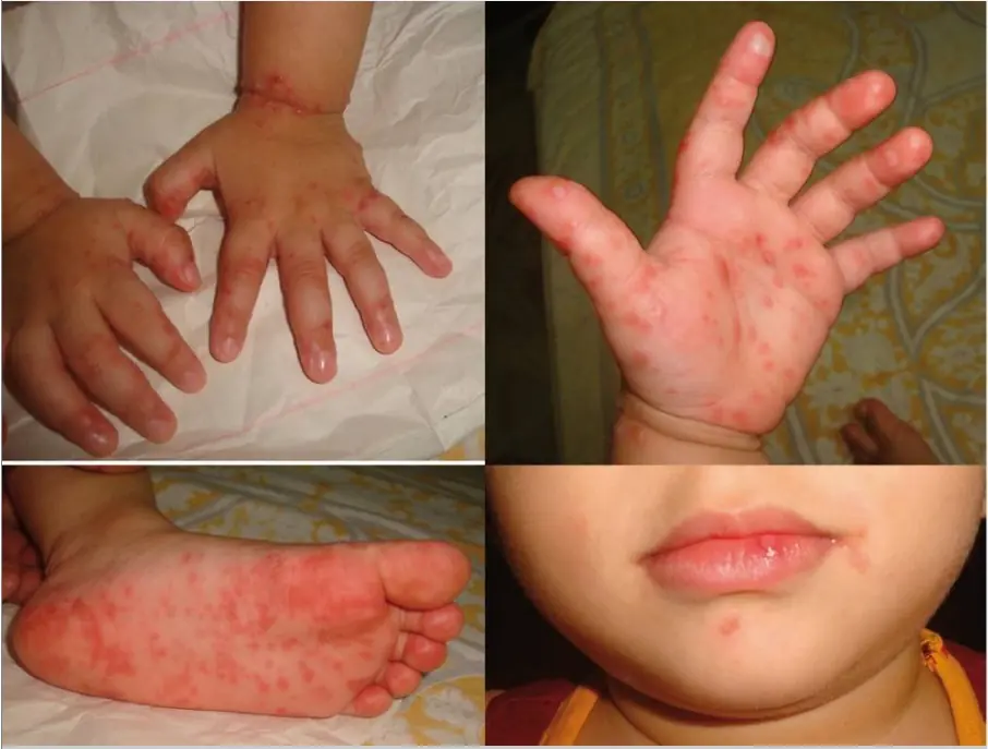 Hand, Foot and Mouth Disease representation