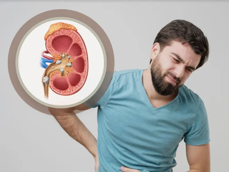 Kidney Stones representation