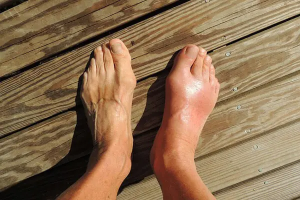 Gout representation
