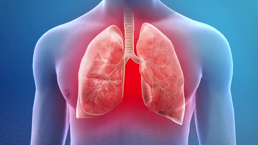 Pneumonia representation