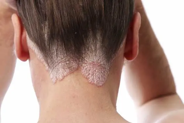 Seborrheic Dermatitis representation