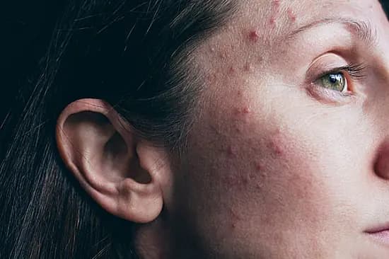 Acne representation