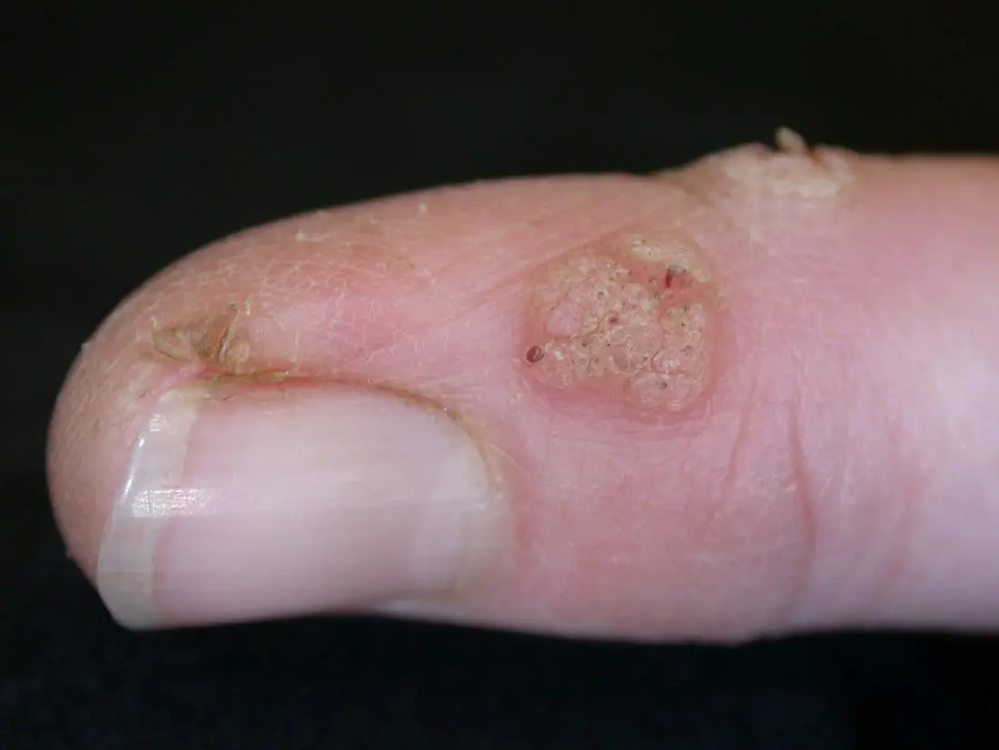 Warts representation