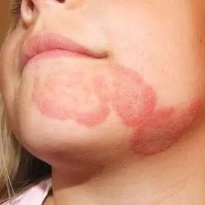 Fungal Infections (Tinea) representation